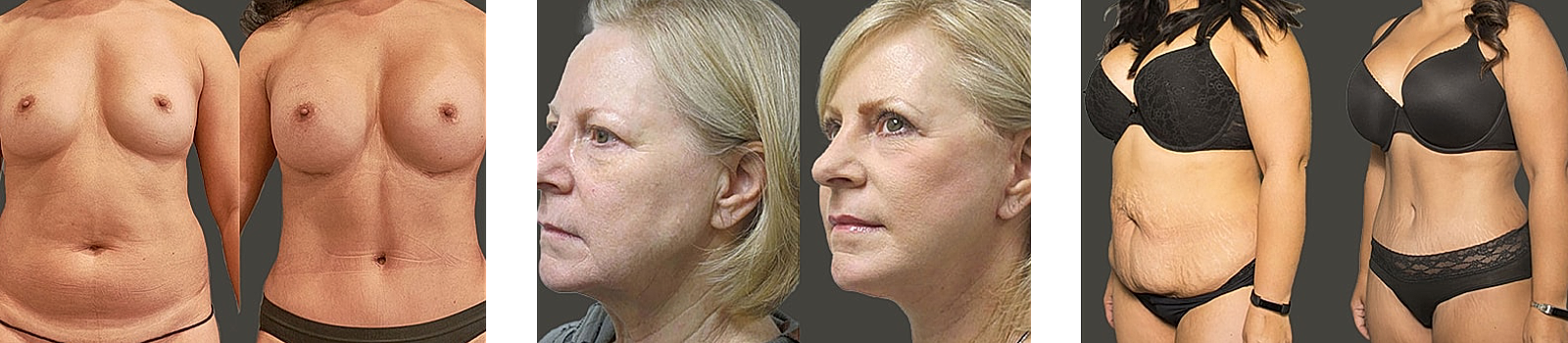 Before and after cosmetic surgery transformations.
